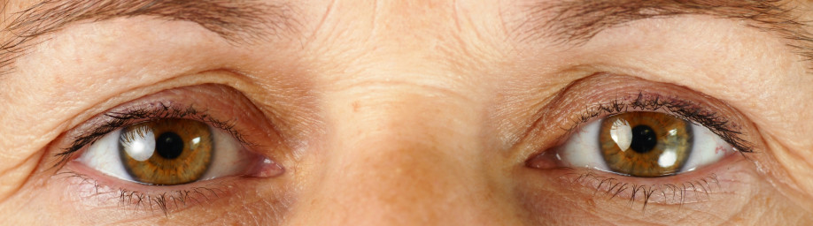 Glaucoma
