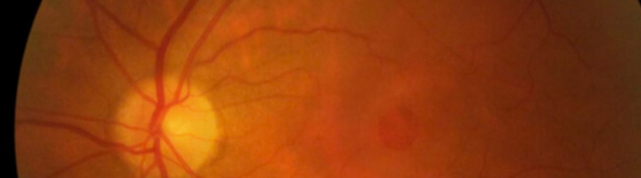 Buraco Macular