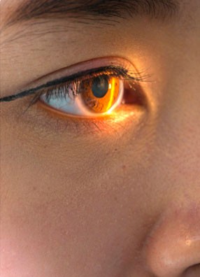 Implante de Anel de Ferrara